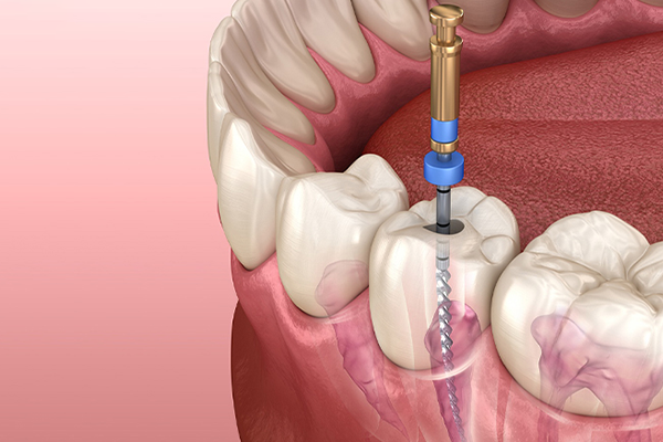 Root Canal Treatment